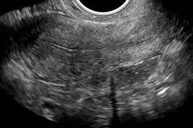 Endometriosis (usually only done after ultrasound) pain in the lower belly (abdominal) area Normal Uterus Ultrasound How To