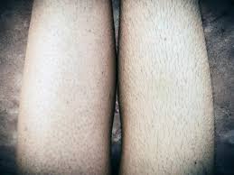 They cause redness and irritation and make your skin feel bumpy instead of silky smooth. How To Get Rid Of Strawberry Legs Treatment And Prevention