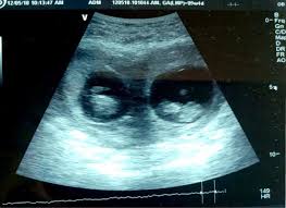 Check spelling or type a new query. Ultrasound At 9 6 Weeks Showing Bicornuate Uterus With Twin Pregnancy Download Scientific Diagram