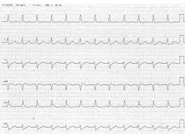 Reentrant supraventricular tachycardias (svt) involve reentrant pathways with a component above the bifurcation of the his bundle. Tachykardie Zum Xten Neues Zur Avnrt Dasfoam Think Tank