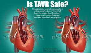 Is Tavr Safe Icu Nursing Aortic Valve Replacement Heart Valves