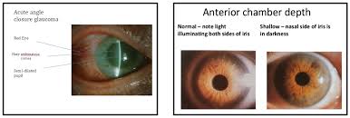 Learn vocabulary, terms and more with flashcards, games and other study tools. Acute Angle Closure Glaucoma Review Canadiem
