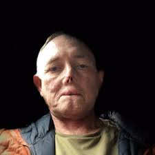 Jaco Nel, el doctor que perdió sus piernas y el rostro por las lamidas de  su perro