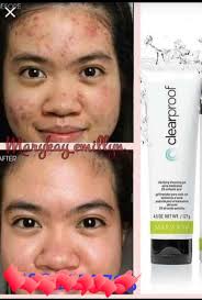 Tratamientos contra el acné