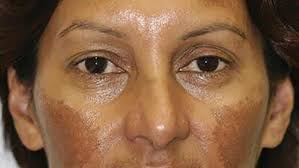 Image result for Melasma