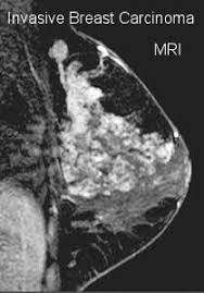 Inflammatory breast cancer (ibc) is rare and is sometimes thought to be some kind of infection. Mri Breast Cancer Detection