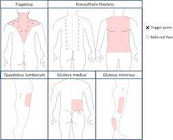 Myofascial Pain Syndromes In The Emergency Department What Are We Missing Journal Of Emergency Medicine