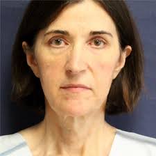 Facelift Before and After Photos by Brian Windle, MD; Aspen, CO