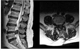 Search picture of bulging disc. T2w Mri Showing A Huge L4 L5 Herniated Disc Download Scientific Diagram