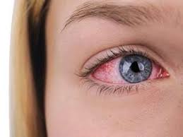 Image result for Conjunctivitis