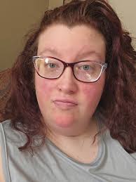 I posted my reaction to insect bites and some people find it difficult to  believe they were caused by a bite. However, it's a well recognised  reaction for lupus patients. Here Professor