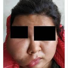 Examinations used in the diagnosis of Madelung's disease.