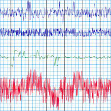Screen Recording Of The Polygraph Test Charts Of A Lie Detector