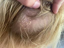 Image result for white scabs on the head in children