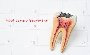 Learn about each treatment option & the signs that may indicate you need one of these common procedures. 7 Tips To Care Root Canal Tooth For Successful Results