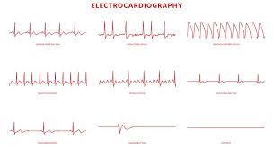 Electrodes are placed on your chest to record your heart's electrical signals, which. Mooci Ekg Schau Auf Deine Herzgesundheit