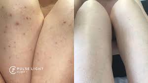 Lasers are also great for dealing with pigmentation from acne and traumatic scars too! Ingrown Hair Removal Pulse Light Clinic London
