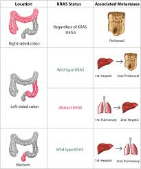 Nearly all colon cancers begin as noncancerous most expert organizations do not recommend that most people take these medicines to prevent colon. Metastatic Profile Of Colorectal Cancer Interplay Between Primary Tumor Location And Kras Status Journal Of Surgical Research