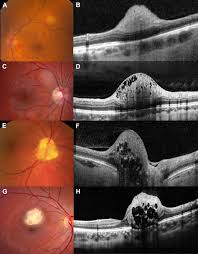 This is not a malignant tumor, and it grows at the same. Retinal Astrocytic Hamartoma Arises In Nerve Fiber Layer And Shows Moth Eaten Optically Empty Spaces On Optical Coherence Tomography Ophthalmology