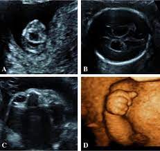 Fetal ultrasound during pregnancy can also give information about the possibility of trisomy 18 or 13, but ultrasound is not 100 percent accurate because some babies with trisomy 18 and 13 may look the same on ultrasound as those without the syndrome. Ultrasound Features In Trisomy 13 Patau Syndrome And Trisomy 18 Edwards Syndrome In A Consecutive Series Of 47 Cases Abstract Europe Pmc