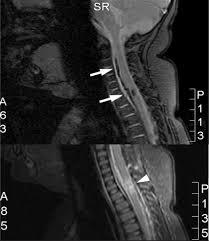 Image result for Spinal Trauma