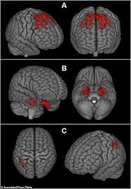 Brain Scans May Reveal Signs Of Cte In Living Nfl Players In 2020 Brain Scan Nfl Players Live Nfl