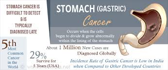 Depends on how the cancer has developed and the stage. Stomach Cancer Gastric Cancer