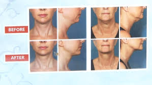 How to get a jawline like brad pit, ariana grande, angelina jolie or other models is a question some individuals are looking to solve, in order to look more. Lose Fat Jawline Parnoon Lau