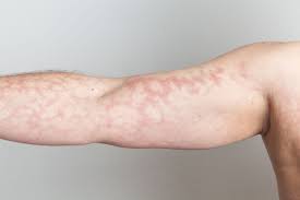 Skin conditions it is not uncommon for babies to get skin rashes. Mottled Skin Causes And Treatments