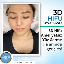 3d Hi Fu Ameliyatsiz Yuz Germe Incoming Call Screenshot Incoming Call