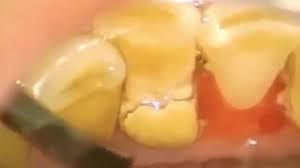 Removing plaque from your teeth daily is crucial for maintaining a healthy mouth. Long Overdue Plaque Removal Youtube