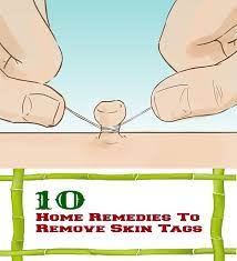 12 Effective Home Remedies To Remove Skin Tags Remove Skin Tags Naturally Skin Tags Home Remedies Skin Tag Removal