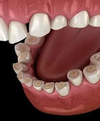 Image result for Tooth Attrition