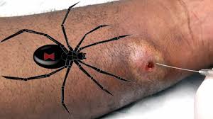 Black widow bite symptoms & treatment. Black Widow Spiders Dr Gilmore S Spider Bites Youtube