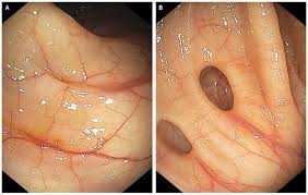 Image result for Diverticulitis