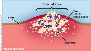 Abscess (For Teens) - Nemours Kidshealth