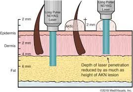 Coarse dark hair, such as. Selection Criteria And Techniques For Improved Cosmesis And Predictable Outcomes In Laser Hair Removal Treatment Of Acne Keloidalis Nuchae Jaad Case Reports