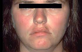 You can repeat this a few times until the redness has gone. 10 Reasons Your Face Is Red