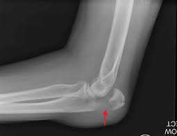 The olecranon /oʊˈlɛkrənɒn/, from the greek olene meaning elbow and kranon meaning head, is a large, thick, curved bony eminence of the ulna, a long bone in the forearm that projects behind the elbow. Olecranon Fracture Causes Symptoms Diagnosis Treatment Prognosis