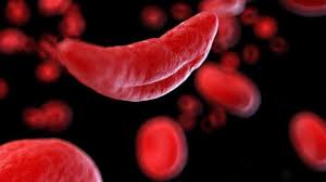 Sickle cell disease is the most common inherited blood disorder in the united states. Tweaking Gene Therapy Scientists Experimentally Boost Red Blood Cells To Aid Sickle Cell And Other Hemoglobin Diseases