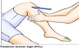 Image result for PCL Sulcus Test