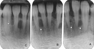 Multifocal Lateral Periodontal Cysts A Report Of 4 Cases And Review Of The Literature Oral Surgery Oral Medicine Oral Pathology Oral Radiology And Endodontics