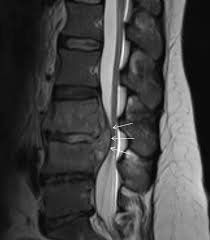 Image result for Spinal Epidural Abscess