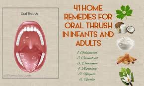 41 Home Remedies For Oral Thrush In Infants And Adults Can Help To Treat Soreness B Natural Headache Remedies Oral Thrush Remedies Home Remedies For Arthritis