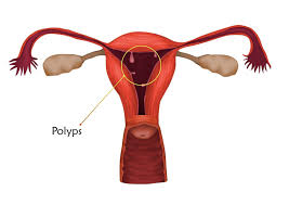 Nach der ersten fg dauerte es bei mir 7 wochen (ohne as), nach der 2. Polypen Ein Moglicher Grund Eines Unerfullten Kinderwunsch