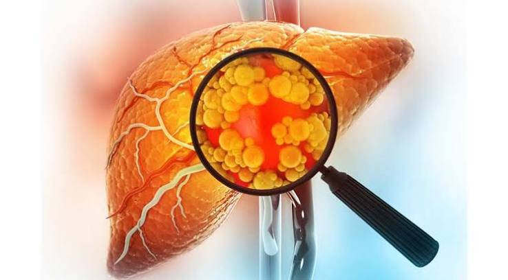 Fatty Liver Disease Is A Serious Risk - FCP Live-In