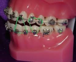 Showing how i put rubberbands (elastics) on my braces. Emergency Care Goldreich Orthodontics Plano Tx