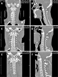 Scielo Brasil Retrospective Analysis Of A Case Series Of Patients With Traumatic Injuries To The Craniocervical Junction Retrospective Analysis Of A Case Series Of Patients With Traumatic Injuries To The
