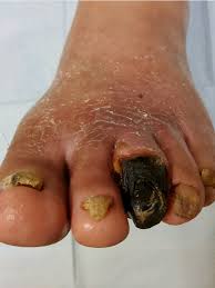 Image result for toe black diabetes