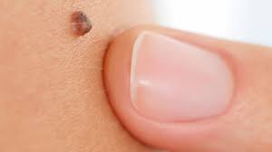Is a raised mole always cancerous? Could Your Mole Be Cancerous Take This Nhs Quiz To Find Out Whether You Need To Get It Checked Huffpost Uk Life